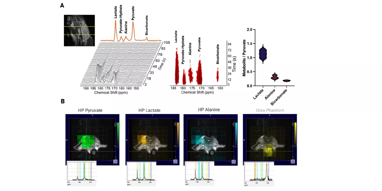 Schematic of a co-clinical imaging study using hyperpolarized ^13C MRI to assess treatment response in metastatic small-cell neuroendocrine prostate cancer (SCNC). Patient-derived xenograft models of liver and bone metastases undergo baseline multiparametric proton MRI and HP ^13C MRI, carboplatin treatment, and follow-up MRI. Representative anatomical, ADC, and pyruvate-to-lactate conversion (kPL) images and quantitative plots compare bone and liver tumors and treatment groups, illustrating the use of clin