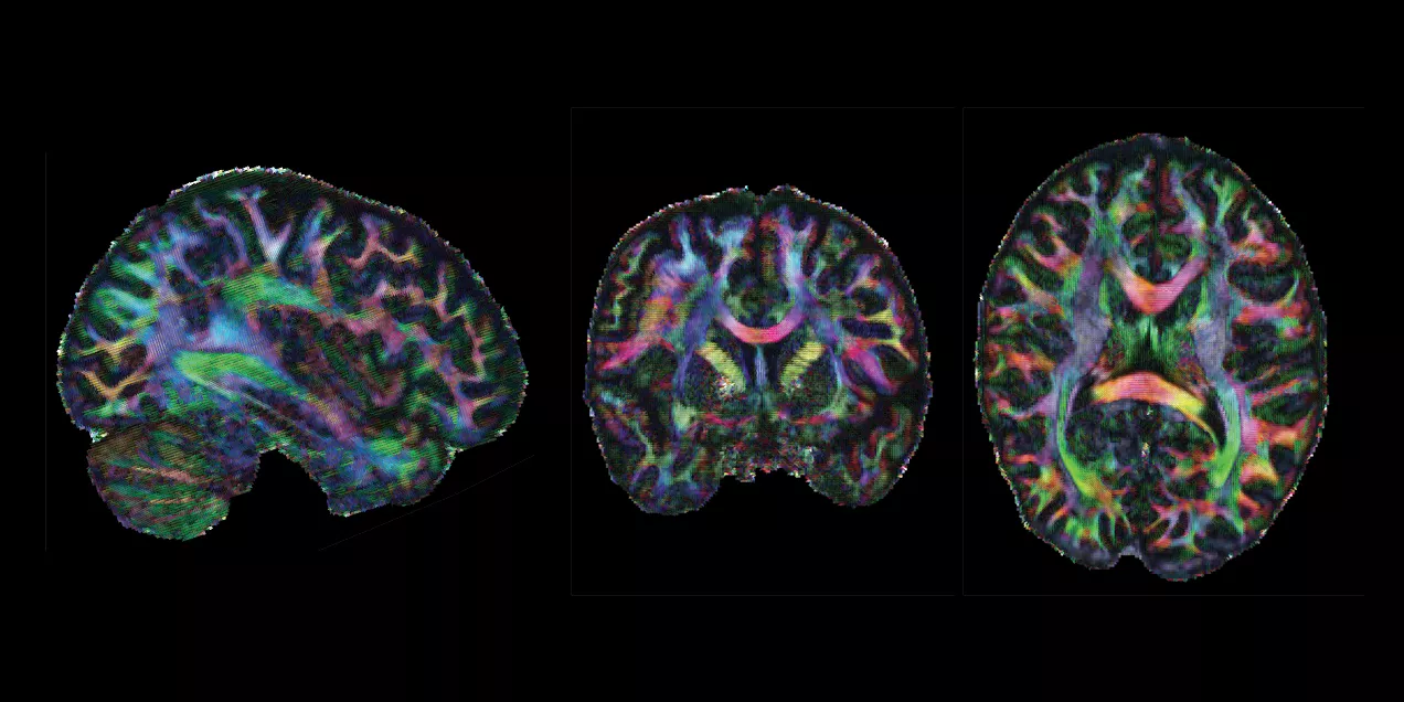 Three diffusion MRI brain scans shown from side, front, and top views, with multicolored fiber pathways highlighting the brain’s white matter connections against a black background.