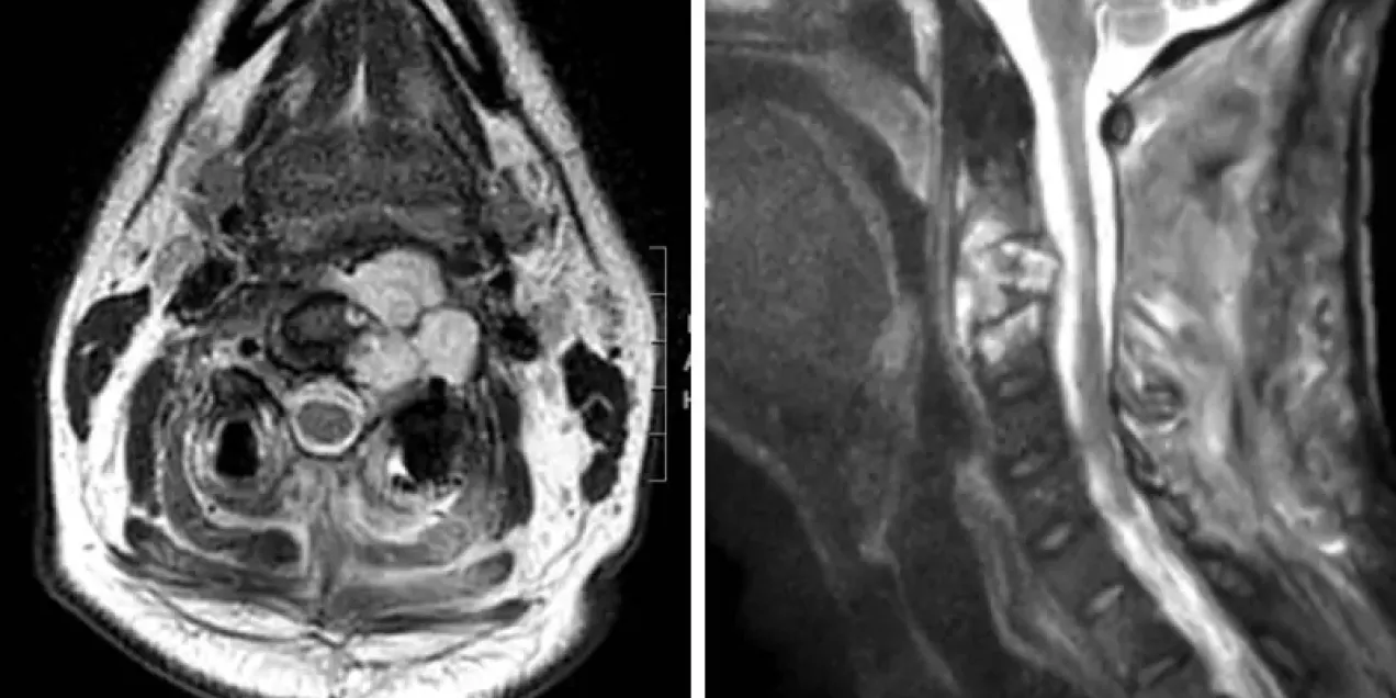 Axial and sagittal MRI scans showing a mass in the upper cervical spine and neck region.