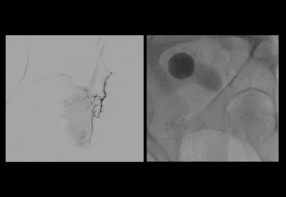 side-by-side fluoroscopic images showing pelvic vascular anatomy; the left panel displays a contrast-filled arterial tree with catheter in place, and the right panel shows a round radiopaque marker and surrounding bony structures during prostate artery embolization