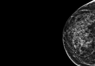 Mammogram image of the right breast showing dense breast tissue with a circular marking highlighting an area of interest.