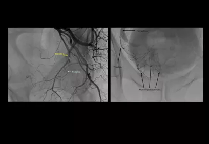 side-by-side fluoroscopic images of the pelvic arteries during prostate artery embolization; the left panel shows contrast outlining the obturator artery and prostatic artery, and the right panel shows a microcatheter positioned with contrast filling small intraprostatic arterial branches