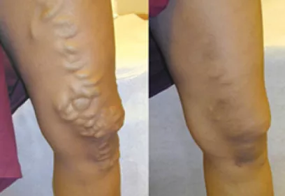 varicose veins on legs shown before and after treatment, with bulging veins reduced in the comparison photos