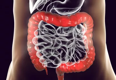 3-D digital rendering of the large intestine in red and transparent gray, overlaid on a patient’s torso, illustrating a non-invasive CT colonography screening.