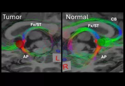 Composite brain MRI images showing axial, coronal, and sagittal views with highlighted regions and tractography. Side by side comparison labeled Tumor and Normal demonstrates white matter fiber pathways connecting frontal cortex and subcortical structures, with colored streamlines indicating altered connectivity near a lesion.