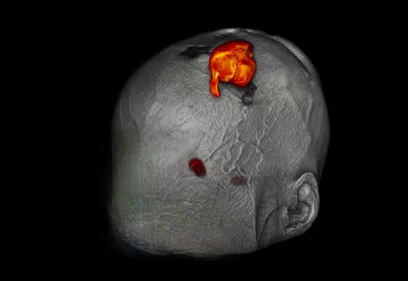 3D head rendering with highlighted meningioma tumor in red on skull surface