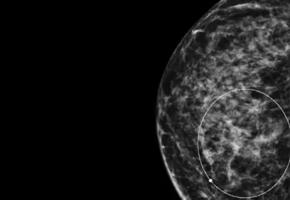 Mammogram image showing dense breast tissue with a circled area highlighting a suspicious region for further evaluation. The image illustrates how mammography is used to identify potential breast abnormalities and detect breast cancer.