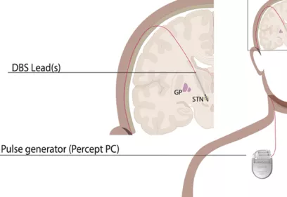 Medical illustration showing a deep brain stimulation (DBS) system. The diagram depicts implanted electrodes placed in targeted brain regions and connected by a lead to a pulse generator implanted in the chest, which delivers electrical stimulation to help manage neurological disorders.