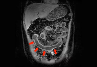 Black-and-white MRI enterography image of the abdomen showing loops of the small intestine. Four red arrows highlight a section of bowel in the lower abdomen to indicate an area of interest or abnormality.
