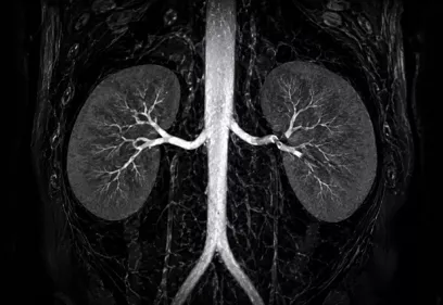 MR angiography image of the kidneys and renal arteries showing narrowing of a renal artery consistent with stenosis.