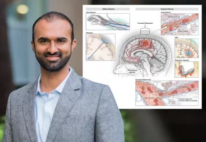 Composite image featuring physician Kazim Narsinh, MD, alongside a medical illustration of focused ultrasound technology. Dr. Narsinh is shown in a professional outdoor portrait wearing a light gray blazer and blue collared shirt. The accompanying diagram depicts targeted drug delivery methods in the brain, including focused ultrasound, blood-brain barrier opening, and therapeutic delivery pathways, highlighting advances in image-guided neurological treatment.