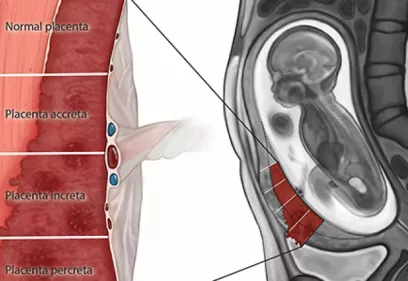 Medical illustration showing the spectrum of placenta accreta disorders during pregnancy. The image compares normal placental attachment with placenta accreta, increta, and percreta, alongside an MRI-style view of a fetus in the uterus highlighting abnormal placental invasion into the uterine wall.