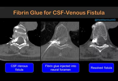 Educational medical graphic illustrating the treatment of a cerebrospinal fluid (CSF) venous fistula using fibrin glue. Three CT scan images are shown side by side. The first image identifies the CSF venous fistula, the second shows fibrin glue being injected into the neural foramen, and the third demonstrates resolution of the fistula after treatment. Labels beneath each image explain the progression from diagnosis to successful treatment.