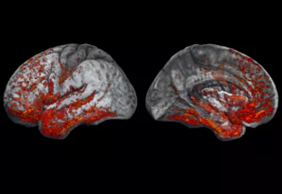 Two side-by-side 3D renderings of the human brain shown against a black background. The brain surfaces are displayed in grayscale, with numerous red and orange highlighted regions overlaid across the cortex. The highlighted areas are concentrated along the lower temporal and occipital regions and extend into portions of the frontal and parietal lobes. The left image shows a lateral (outer side) view of the brain, while the right image shows a medial (inner side) view. The colored overlays appear to represen