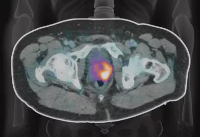 Axial PSMA PET/CT image of the pelvis showing concentrated radiotracer uptake within the prostate gland, used to detect and stage prostate cancer.