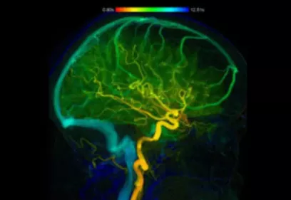Color-coded medical image of the brain showing a network of blood vessels and cerebral circulation. The image uses a spectrum of colors to represent blood flow within the brain's vascular system, highlighting major arteries and branching vessels in a side view of the head.