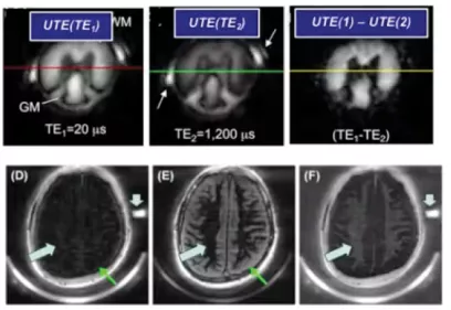 Medical imaging figure showing ultrashort echo time MRI scans of the brain. The top row compares UTE images captured at different echo times and a subtraction image, while the bottom row shows axial brain images with arrows highlighting areas of interest. The figure illustrates MRI techniques used to evaluate ultrashort-T2 brain tissue components, including myelin-related structures.