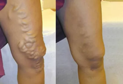 Photographs of legs with varicose veins. The left images show prominent, bulging veins around the knee and lower thigh before treatment, while the right images show the same areas after treatment with significantly reduced visible veins and a smoother appearance.