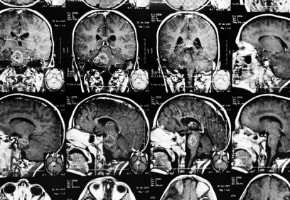 Composite panel of multiple brain MRI images displayed in different views and slices. The scans show detailed cross-sectional images of the brain, including coronal, sagittal, and axial perspectives. A large lesion or tumor-like mass is visible in the central and posterior regions of the brain across several images, demonstrating its size and location relative to surrounding brain structures.