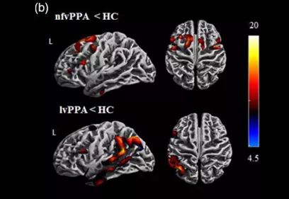 Scientific brain imaging figure comparing patterns of brain activity between individuals with primary progressive aphasia (PPA) and healthy controls (HC). Four brain surface renderings display regions with significant differences, highlighted in red, orange, yellow, and blue. The top row shows findings for the nonfluent variant of PPA (nfvPPA), while the bottom row shows findings for the logopenic variant (lvPPA). A color scale indicates the strength of the observed differences across brain regions.