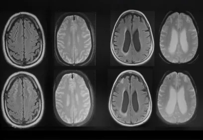 Grid of brain MRI scans displayed side by side, showing multiple cross-sectional views of the brain. The images compare different MRI sequences and illustrate structural changes in brain tissue and ventricular size, highlighting the use of medical imaging to evaluate neurological conditions and disease progression.