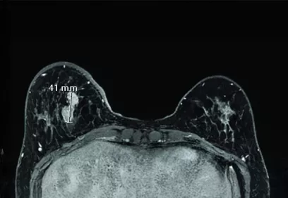 Breast MRI image showing both breasts in a cross-sectional view. A highlighted lesion in the left breast is marked with measurement lines and labeled “41 mm.” Areas of contrast enhancement are visible in both breasts against a dark background, with the measured mass appearing larger and more prominent in the left breast.