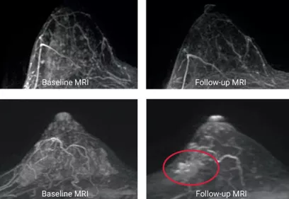 Four breast MRI images arranged in a two-by-two grid comparing baseline and follow-up scans. The top row shows one breast at baseline and follow-up, with similar appearance over time. The bottom row shows another breast at baseline and follow-up, with a circled area on the follow-up MRI highlighting a region of increased enhancement or abnormality. Labels identify each image as either “Baseline MRI” or “Follow-up MRI.”