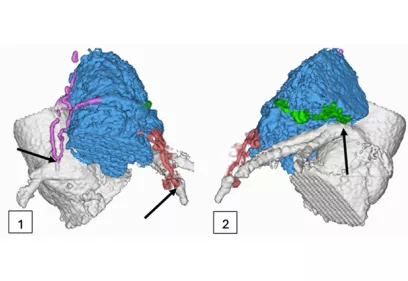 Two 3D cardiac imaging reconstructions compare anatomical variations of the heart and surrounding blood vessels. Color-coded structures highlight the heart chamber in blue and nearby vessels in green, pink, and red. Arrows indicate key anatomical features, illustrating how heart anatomy can differ between individuals.
