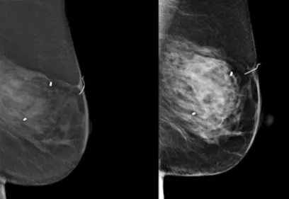Two side-by-side grayscale mammogram images of a breast displayed against a black background. The images show the breast from two different imaging angles, with small radiopaque markers indicating areas of interest for diagnostic evaluation.