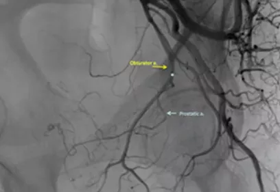 A grayscale angiogram showing blood vessels in the pelvis during a prostate artery embolization procedure. Contrast dye highlights the branching arteries, with arrows labeling the obturator artery and prostatic artery to identify the blood vessels being targeted for treatment.