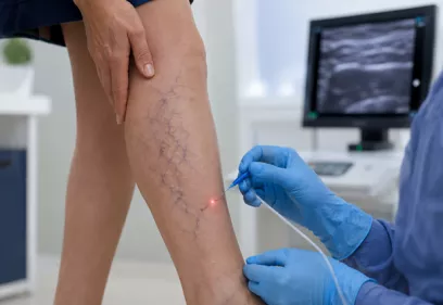 A clinician wearing blue gloves performs a minimally invasive varicose vein procedure on a patient's lower leg in a bright medical clinic. The patient's leg has visible varicose veins, and an ultrasound machine is blurred in the background, indicating image-guided treatment.