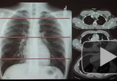 A composite medical imaging graphic showing a chest X-ray alongside several cross-sectional CT scan images of the chest. Red horizontal guide lines overlay the X-ray to indicate the CT scan slice locations, illustrating how CT imaging provides detailed cross-sectional views of the lungs and chest. A play button overlay suggests the image is a video thumbnail.