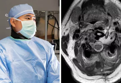 Side-by-side image of a masked neurosurgeon in the operating room and an axial MRI scan of the upper neck before surgery.