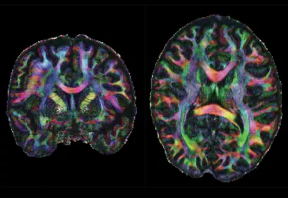 Three diffusion MRI brain scans shown from side, front, and top views, with multicolored fiber pathways highlighting the brain’s white matter connections against a black background.