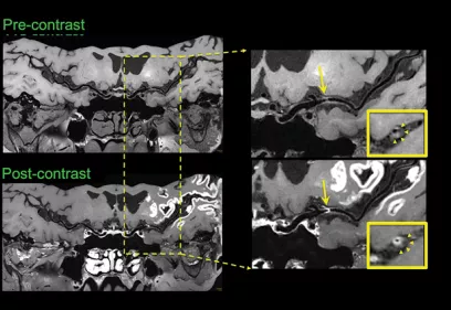 Pre- and post-contrast brain vessel wall MRI images showing a narrowed intracranial artery, with enlarged views highlighting the vessel wall and areas of enhancement.