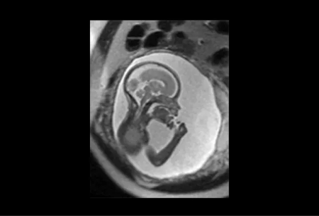 fetal mri baby scan