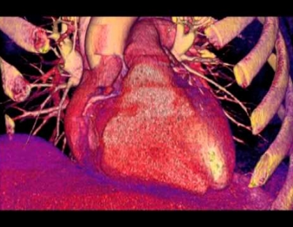Embedded thumbnail for How well do CT scanners see into the heart?