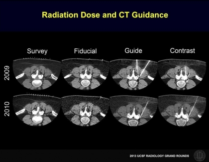Embedded thumbnail for Reducing Radiation Exposure in CT Guided Injections