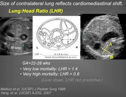 Embedded thumbnail for A New Challenge: Congenital Diaphragmatic Hernia 