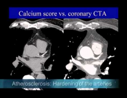Embedded thumbnail for Calcium score vs. coronary CTA