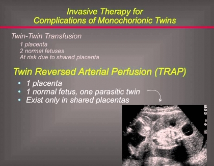 Embedded thumbnail for Operating on Twins in the Womb