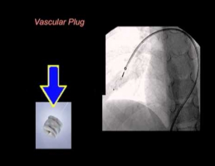 Embedded thumbnail for Fixing a lung malformation