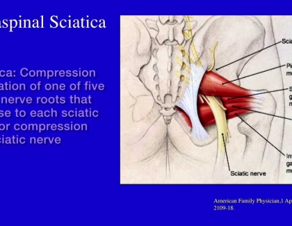 Embedded thumbnail for Understanding Sciatica
