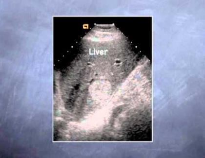 Embedded thumbnail for What can ultrasound tell us?  