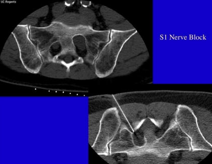 Embedded thumbnail for Back Pain Related to Tarlov Cysts