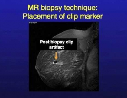 Embedded thumbnail for How is a MRI-Guided Breast Biopsy done?
