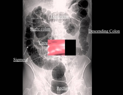 Embedded thumbnail for Inflating the Colon for Better View 