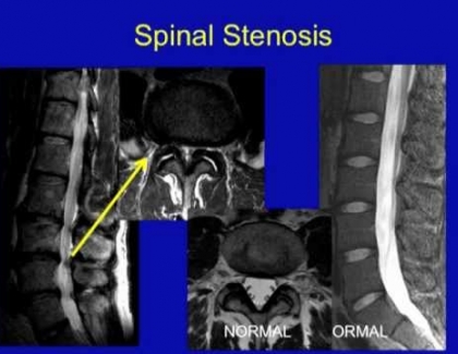 Close up on spinal stenosis