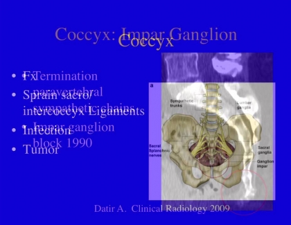 Embedded thumbnail for Back Pain Related to the Coccyx