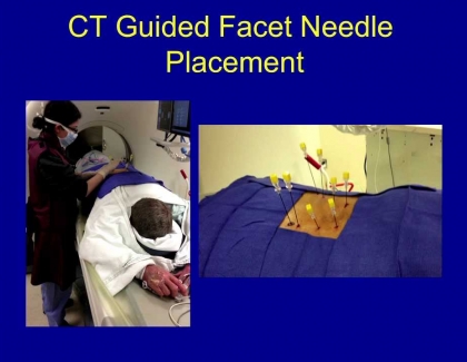 Embedded thumbnail for Advantages of CT versus Fluoroscopy